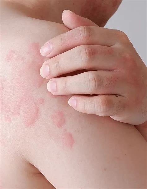 scratch test hives|skin test for hives pictures.